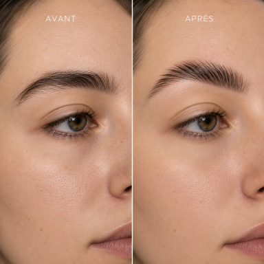 Brow Lift